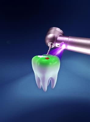 Fluoresce HD Handpiece And Tooth Image Sept 2025.jpg