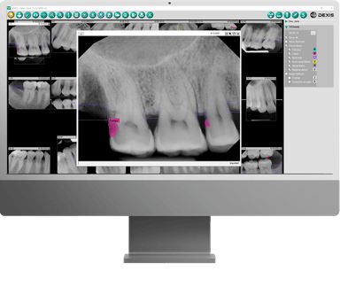 2D AI Dental Findings