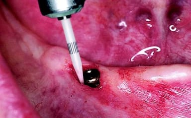CeraTip™ Tissue Trimmer