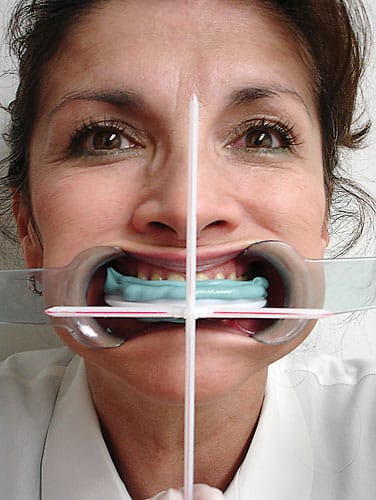 Facial Plane Relator