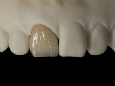 PFM Crowns