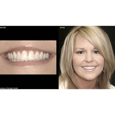 da Vinci Veneers