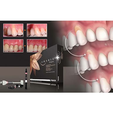 Amaris Gingiva