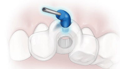 IrriGUIDE Adapter 