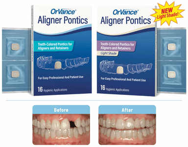 OrVance® Aligner Pontics