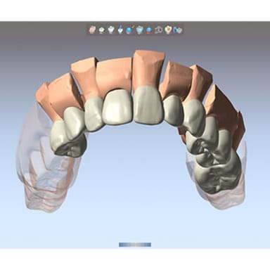 DentalCAD Upgrade