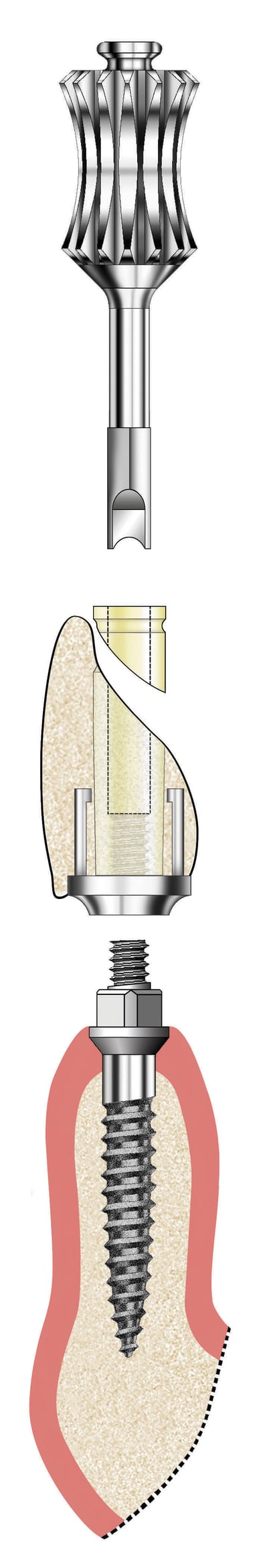 Anew Narrow Diameter Implant