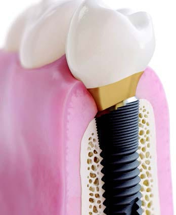 OsseoSpeed Profile EV