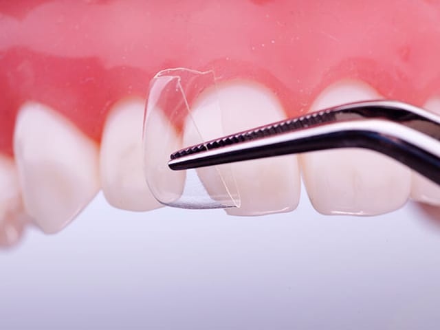 Directa CoForm - For temporary and permanent Class IV composite restorations