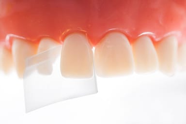 Directa ProxyPal® - The pre-shaped progressive curvature aids to create incisial fillings with a correct anatomical shape