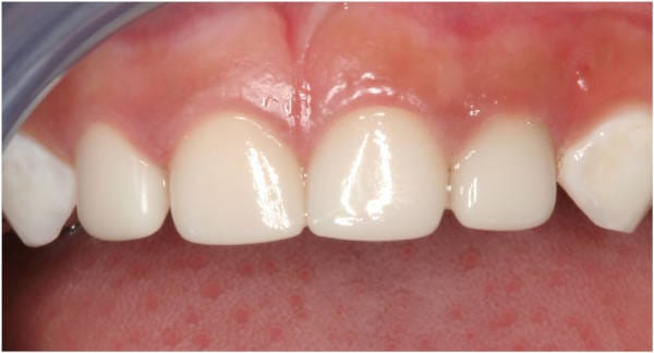 EZ-Pedo Pediatric Zirconia Crowns