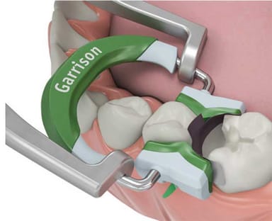 Composi-Tight 3D Fusion Sectional Matrix