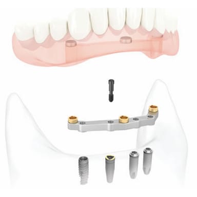 NOBELPROCERA IMPLANT BAR