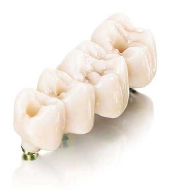 NobelProcera Implant Bridge in High-Translucency Multilayered Zirconia