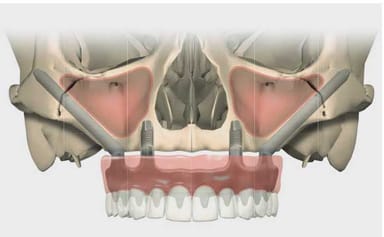 NobelZygoma Implant System
