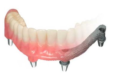 Prism Implant Bar