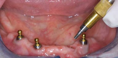 Sphero Flex for Implants