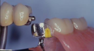 Castable Spherical Attachment (CSA)