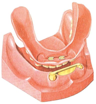 Hader Bars and Clips