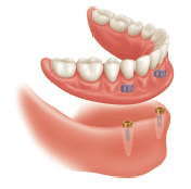 Zest Anchors Locator Root Attachment Kit