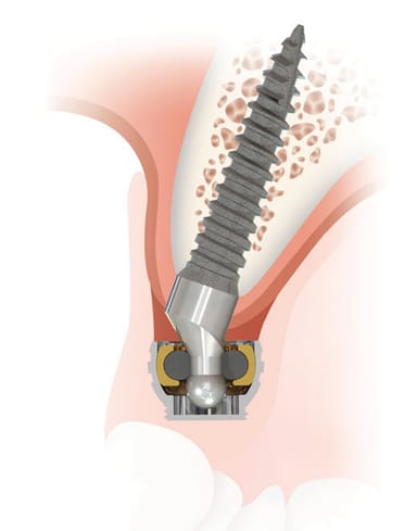SATURNO Narrow Diameter Implant System