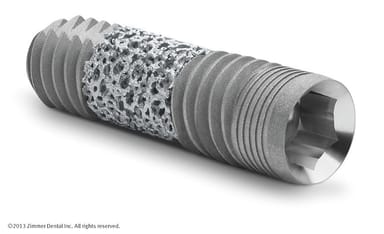 Zimmer 3.7mmD Trabecular Metal Dental Implant